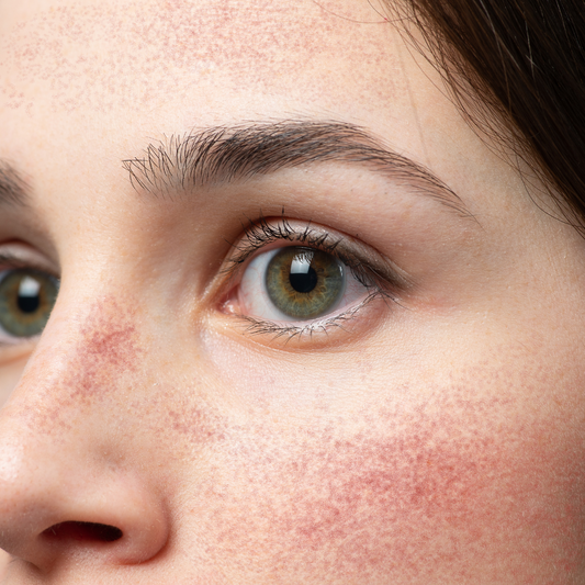 Кожа с розацея- правилната козметика и рутина